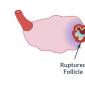 Необходимо знать сколько фолликулов должно быть в яичнике для зачатия